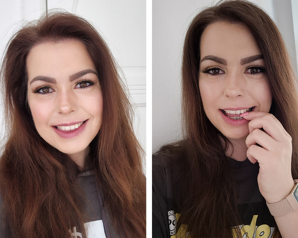 Fått min första tandställning